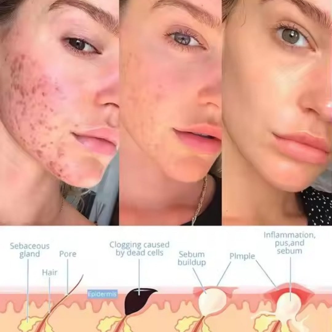 AcniLume™ - Facial Wand