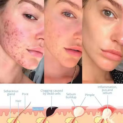 AcniLume™ - Facial Wand